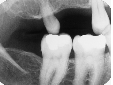 <p>What term best describes this tooth?</p><p> </p><p>supernumerary</p><p> </p><p>peg lateral</p><p> </p><p>microdont</p><p> </p><p>macrodont</p>