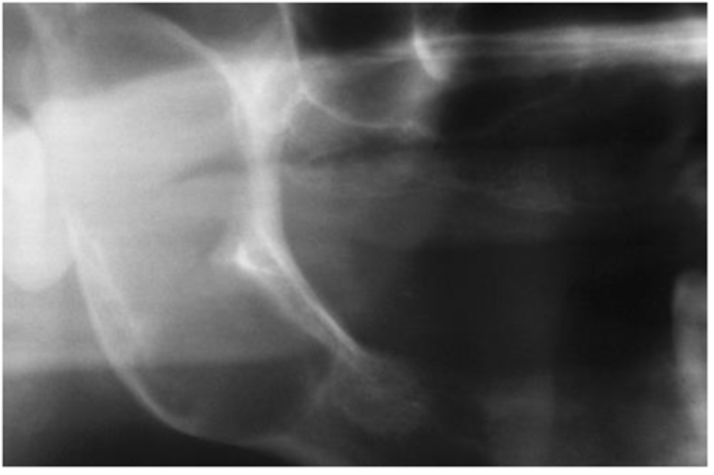 <p>inferior alveolar nerve canal looks extremely expanded</p>
