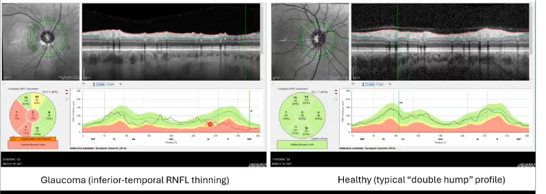 <p>thickness comparison of cpRNFL</p>