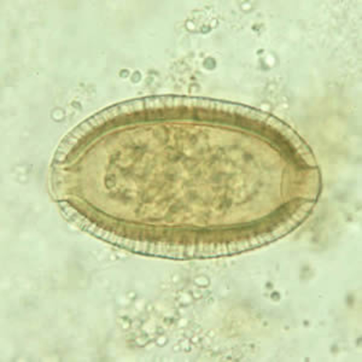 <p>APHASMID nematode; LEMON shaped egg with PITTED shells in LIVER; DEAD-END infection in humans</p><p>MOT: ingestion of EMBRYONATED egg</p>