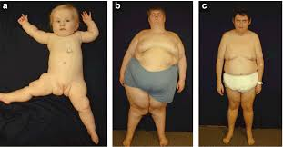 <p>-cause: deletion at 15p1113, inherited from father</p><p>-phenotypes: hypotonia, cognitive deficits, typical facial changes, obesity, and small hands and feet </p>