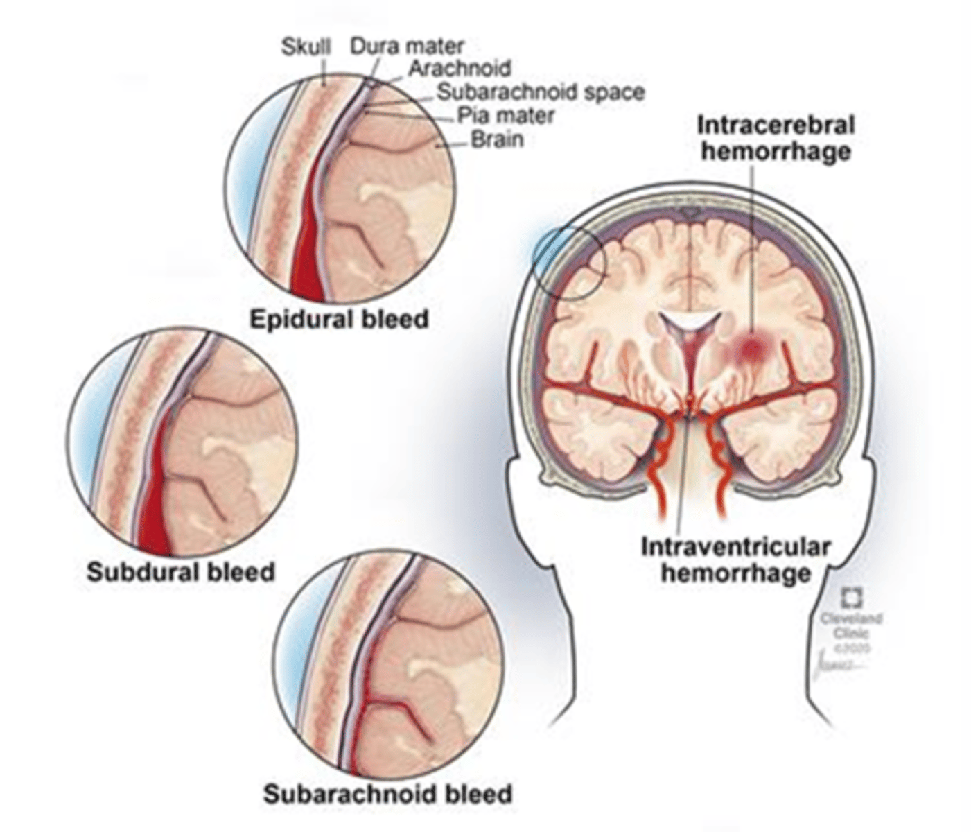 <p>A:</p><p>Ischaemic:</p><p>-sudden focal deficit</p><p>- negative symptoms - loss of function</p><p>(hemiparesis, facial droop, aphasia, Visual loss - amorsis fugax, ataxia)</p><p>ICH:</p><p>- sudden onset of neurosymptoms</p><p>-vomiting, ↓ consciousness, severe hypertension.</p><p>- hyperdensity within brain parenchyma</p><p>SAH: thunderclap headache, neck stiffness, photophobia, collapse.</p><p>- circle of willis shadowing</p><p>* Epidural - lucid period</p><p>subdural - gradual decline</p>