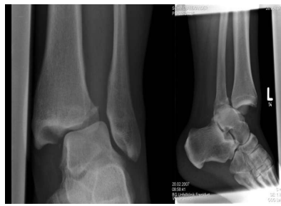 <ul><li><p>Verrenkung</p></li></ul><p></p>