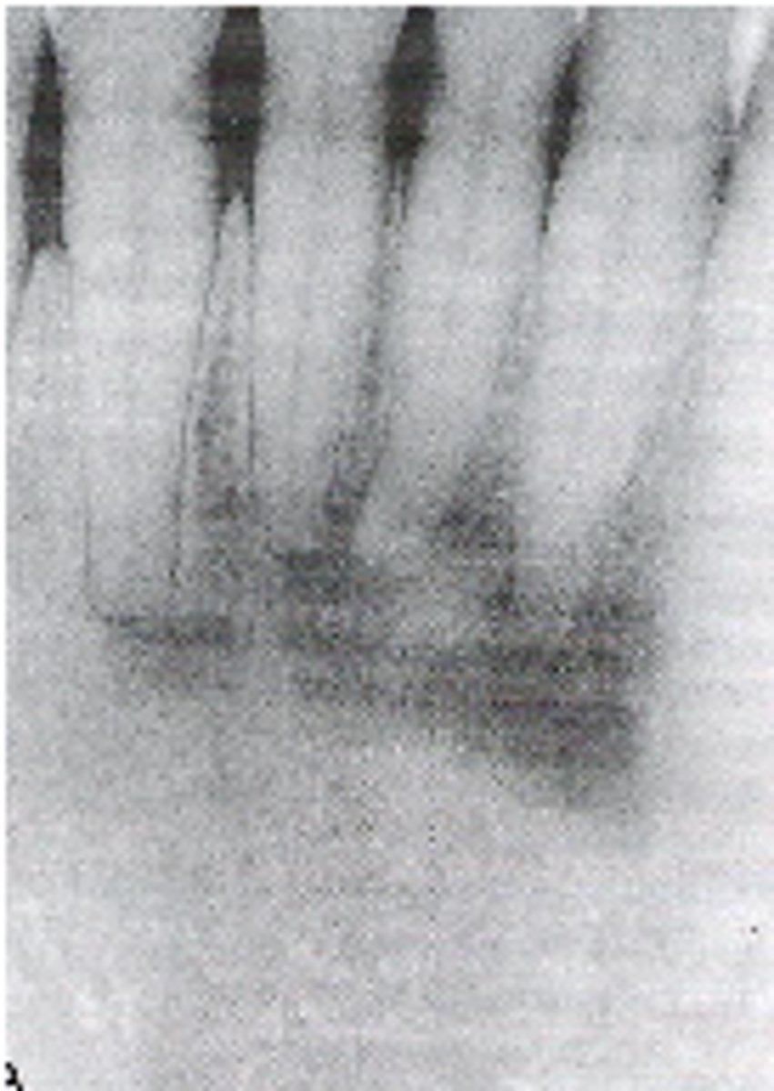 <p>-lesion is asymptomatic and is discovered on routine radiographic examination</p><p>-occurs most commonly in the anterior mandible of patients older than 30 years of age</p><p>-more common in women than men, predilection for this disease in black women</p>
