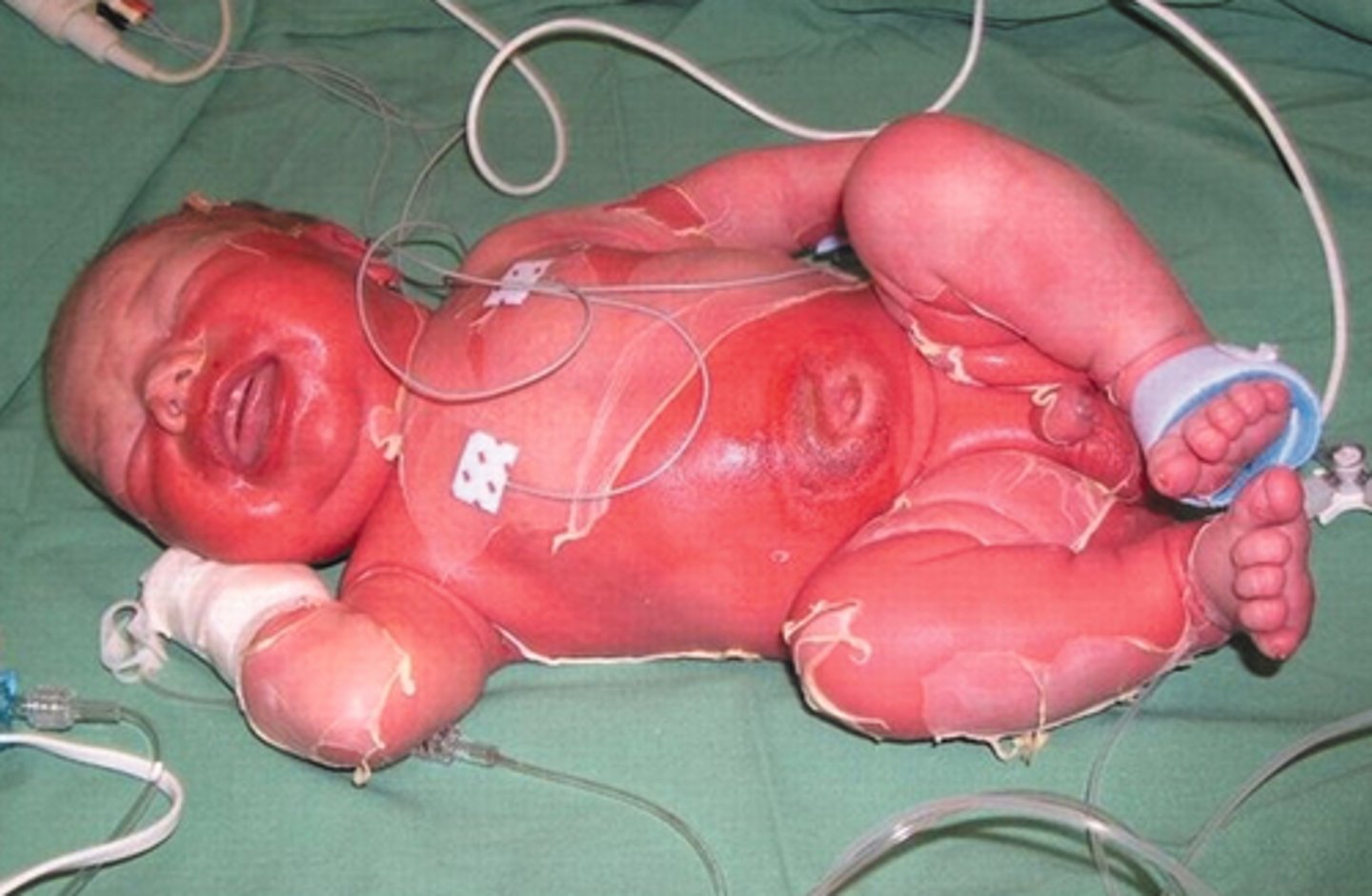 <p>STAPH infection, typically in NEWBORNS, characterized by widespread desquamation of epidermis</p><p>- looks like a burn</p><p>- 5% of S. aureus strains produce exfoliative toxins</p>