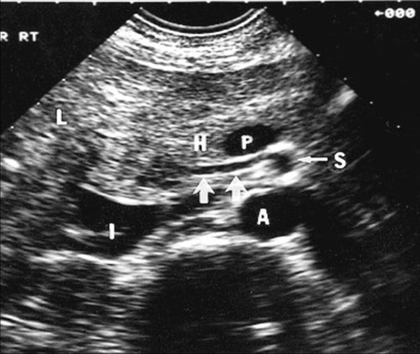 <p>Right hepatic artery branches off something else besides celiac artery - usually SMA</p>