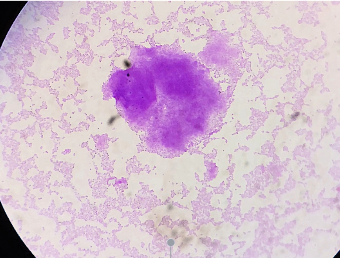 <p><em><mark data-color="#decdff" style="background-color: #decdff; color: inherit">Staphylococcus aureus.</mark></em></p><ul><li><p class="has-focus">Spherical (cocci)</p></li><li><p class="has-focus is-empty">Clusters, resembling grape-like formation<span style="font-size: 1.6rem">s</span></p></li><li><p class="has-focus is-empty"><span style="font-size: 1.6rem">Purple or blue</span></p></li><li><p class="has-focus"><span style="font-size: 1.6rem">Gram-positive</span></p></li><li><p class="has-focus"><span style="font-size: 1.6rem">Skin and soft tissue infections (boils/abscesses), spread through direct contact</span></p></li></ul><p></p>