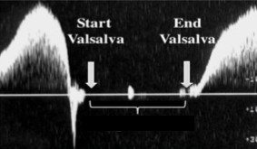 <p>The sonographer is performing a chronic venous insufficiency exam. When the sonographer tells the patient to valsalva, this waveform was seen. </p><ol><li><p>Describe the appearance of this waveform. </p></li><li><p>This waveform can indicate the presence/absence of…</p></li></ol><p></p>