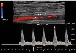 <p>Pt is s/p stent placement x 3 years. pt ABI decreased from previous visit by .15 indicating a hemodynamically significant stenosis.</p><p>consider ultrasound image obtained</p><ol><li><p>what is contributing to the narrowing in stent?</p></li><li><p>is this prox or distal sten edge area?</p></li><li><p>is this ultrasound finding causing the decrease in ABI when compared to previous vist?</p></li></ol><p></p>