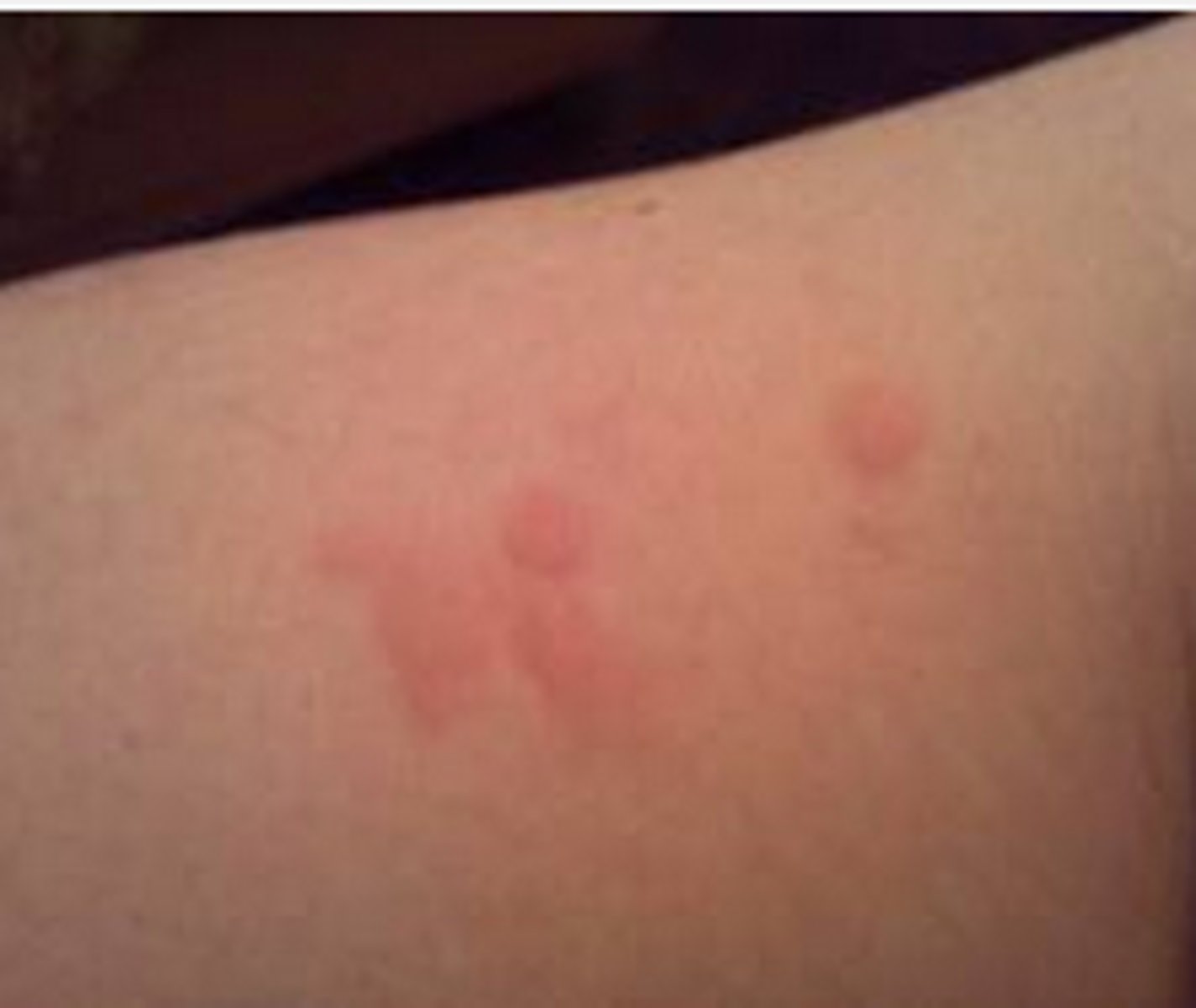 <p>I have rashes</p>
