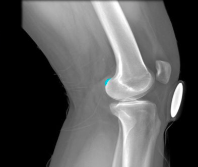 provides distalmost attachment point for tendon of adductor magnus muscle