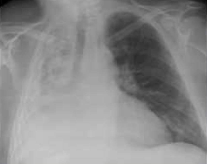 <p>What is the diagnosis based off of this chest x-ray?</p>