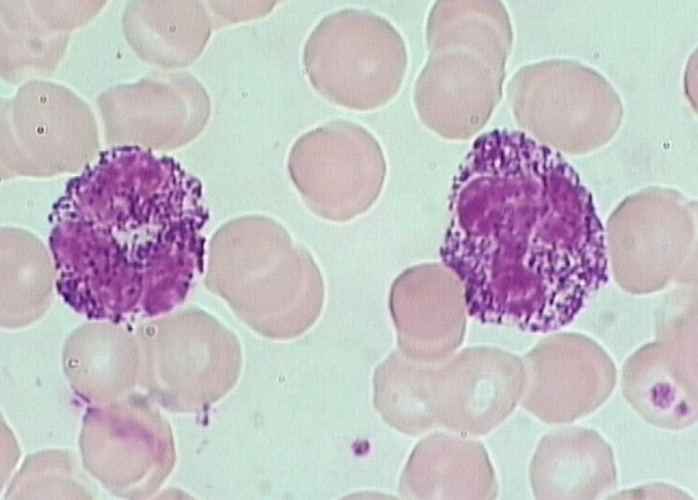 <p>a mucopolysaccharidosis</p><p>- every leukocyte seen exhibits dense, basophilic coarse granulation</p>