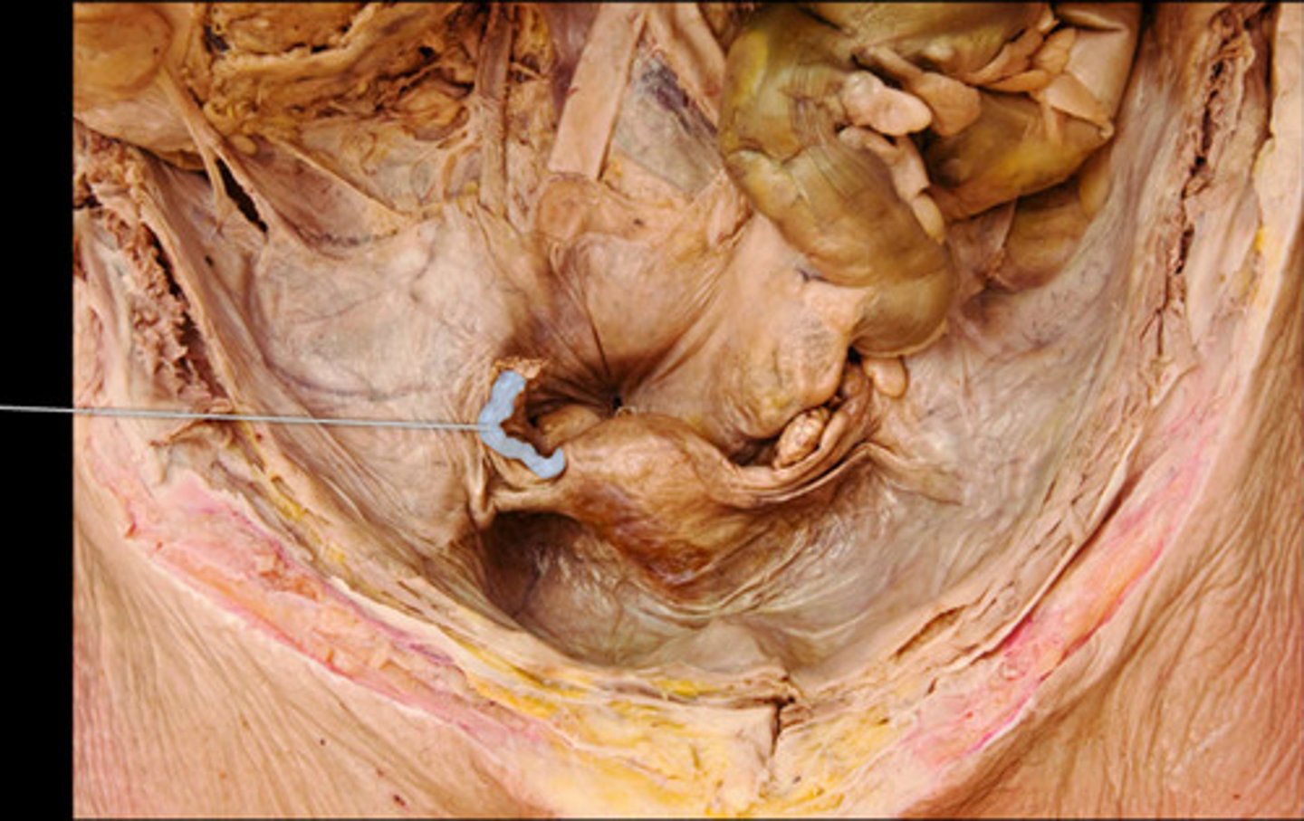 <p>right uterine tube</p>