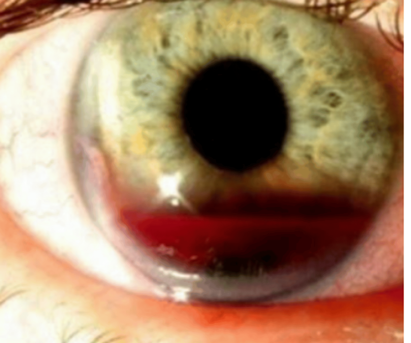 <p>collection of red blood cells in the anterior chamber. Is graded by its height in mm, or by the percentage of anterior chamber involved. May be visible only on gonioscopy (micro). Can be caused by trauma** and uveitis. Is managed with bed rest (head at 45 degrees), minimal eye movement, and avoidance of NSAIDs.</p>