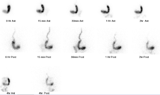 <p><span><span>Delayed gastric emptying with food still in the stomach after 4 hours post meal</span></span></p><p></p>