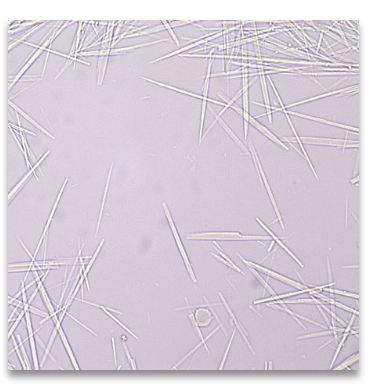 <ul><li><p class=""><strong>Source</strong>: Anti-viral medication (e.g., herpes treatment)</p></li><li><p class=""><strong>Urine pH</strong>: Neutral to slightly alkaline</p></li><li><p class=""><strong>Morphology</strong>: Long, thin, needle-like crystals</p></li><li><p class=""><strong>May be confused with</strong>: Tyrosine crystals</p></li><li><p class=""><strong>Clinical tip</strong>: Confirm with patient medication history</p><p class=""></p></li></ul><p></p>