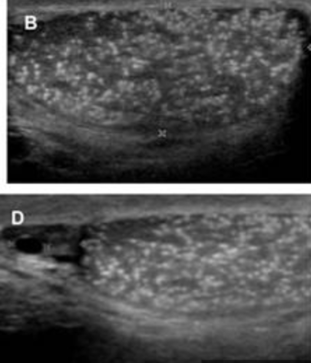 <p>depósitos de calcio o de otras sales minerales que aparecen, en pequeños focos, en el parénquima testicular</p>