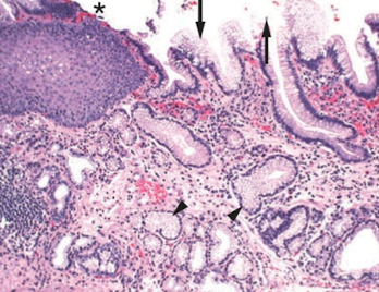 <ul><li><p>intestinal metaplasia (columnar replace squamous) of distal esophagus</p></li><li><p>patches of red, velvety mucosa extending up from gastroesophageal junction </p></li><li><p>increases risk of esophageal adenocarcinoma (cancer)</p></li></ul>