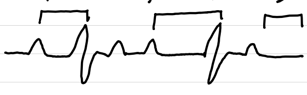 <ul><li><p>rate: varies (<span style="color: red;">ventricular < atrial</span>)</p></li><li><p>rhythm: <span style="color: red;">irregular</span></p></li><li><p>P waves: normal</p></li><li><p>PR interval: <span style="color: red;">varies, lengthens, then none</span></p></li><li><p>QRS complexes: <0.10 sec</p></li><li><p>ST segments: normal</p></li></ul><p></p>
