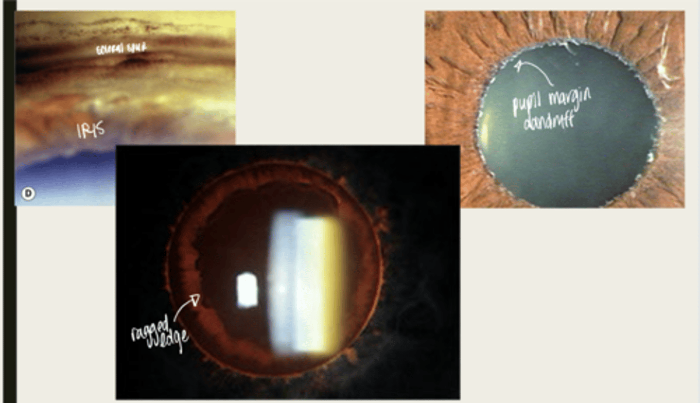 <p>The dandruff like material deposited on the iris in pseudoexfoliation syndrome will look like what?</p>