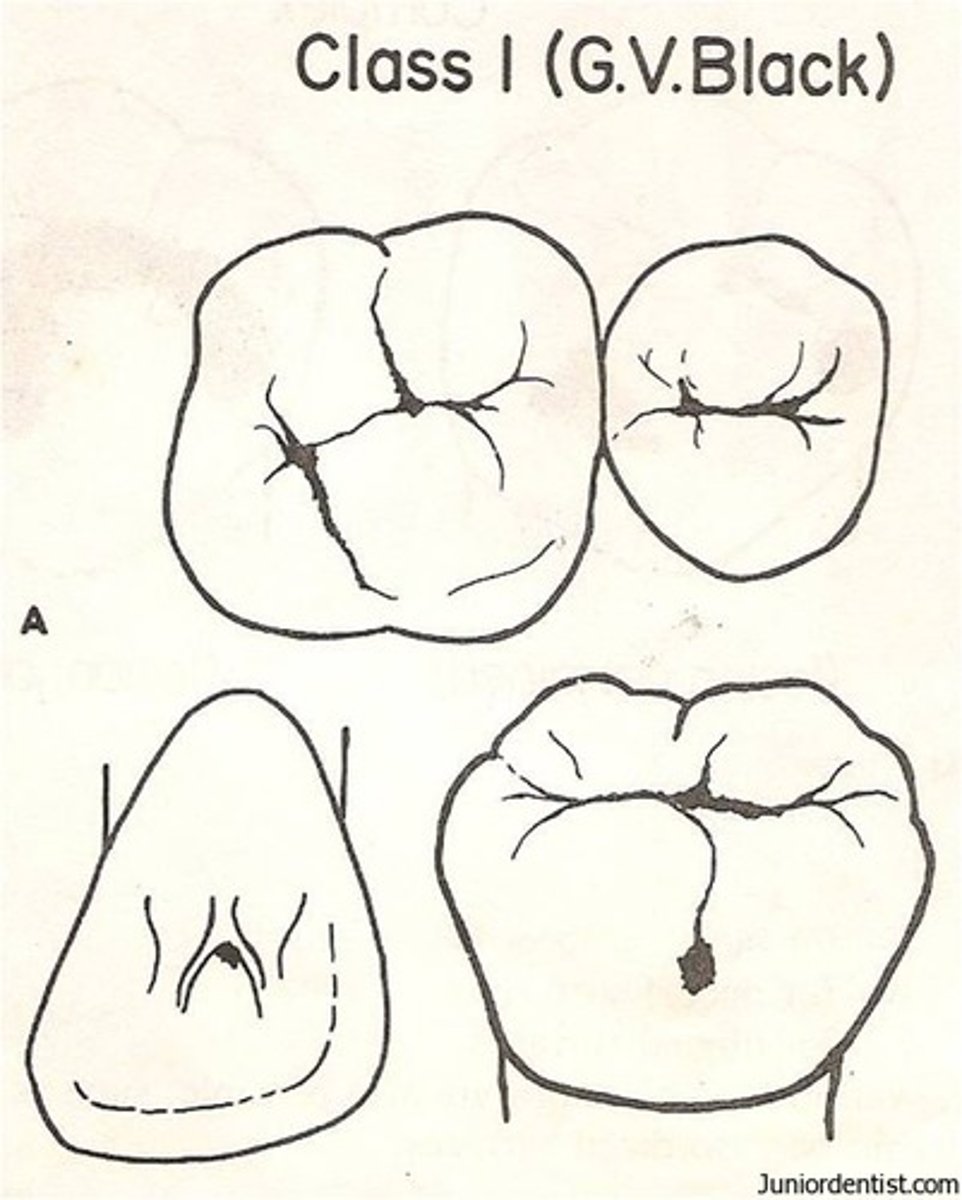<p>pits and fissures of posterior teeth, lingual pits of maxillary incisors</p>