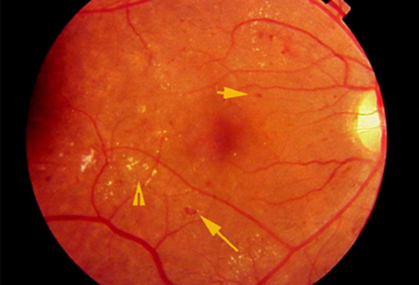 <p>Results from prolonged hypertension or abrupt acute episode</p><p>Tight junctions damaged</p><p>Blood leaks into retina</p><p>-Flame &amp; intraretinal (dot/blot) hemes</p><p>Hard exudates</p><p>Retinal NFL ischemia (CWS)</p>