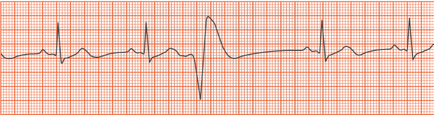 The pictured rhythm is an example of which of the following?


1. Atrial flutter
2. Premature ventricular contraction
3. Sinus bradycardia
4. Ventricular tachycardia