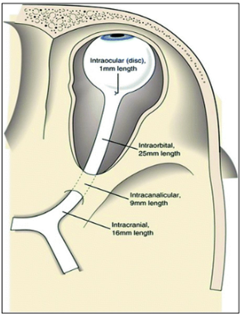 <p>-Intraocular</p><p>-Intraorbital</p><p>-Intracanalicular</p><p>-Intracranial</p>