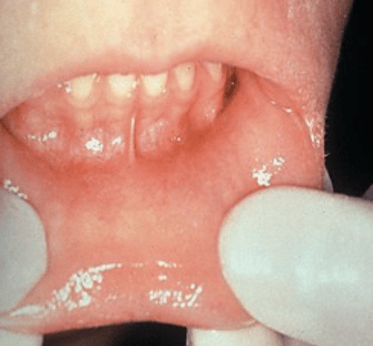 <p>Soreness</p><p>Erythema</p>