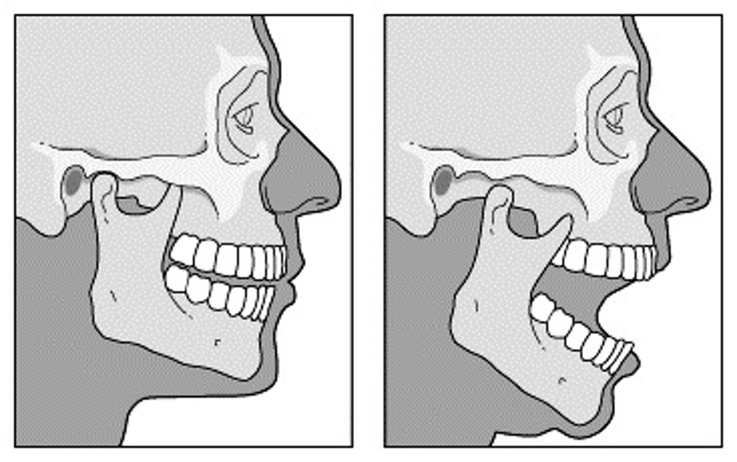 <p>partial dislocation of a joint</p>