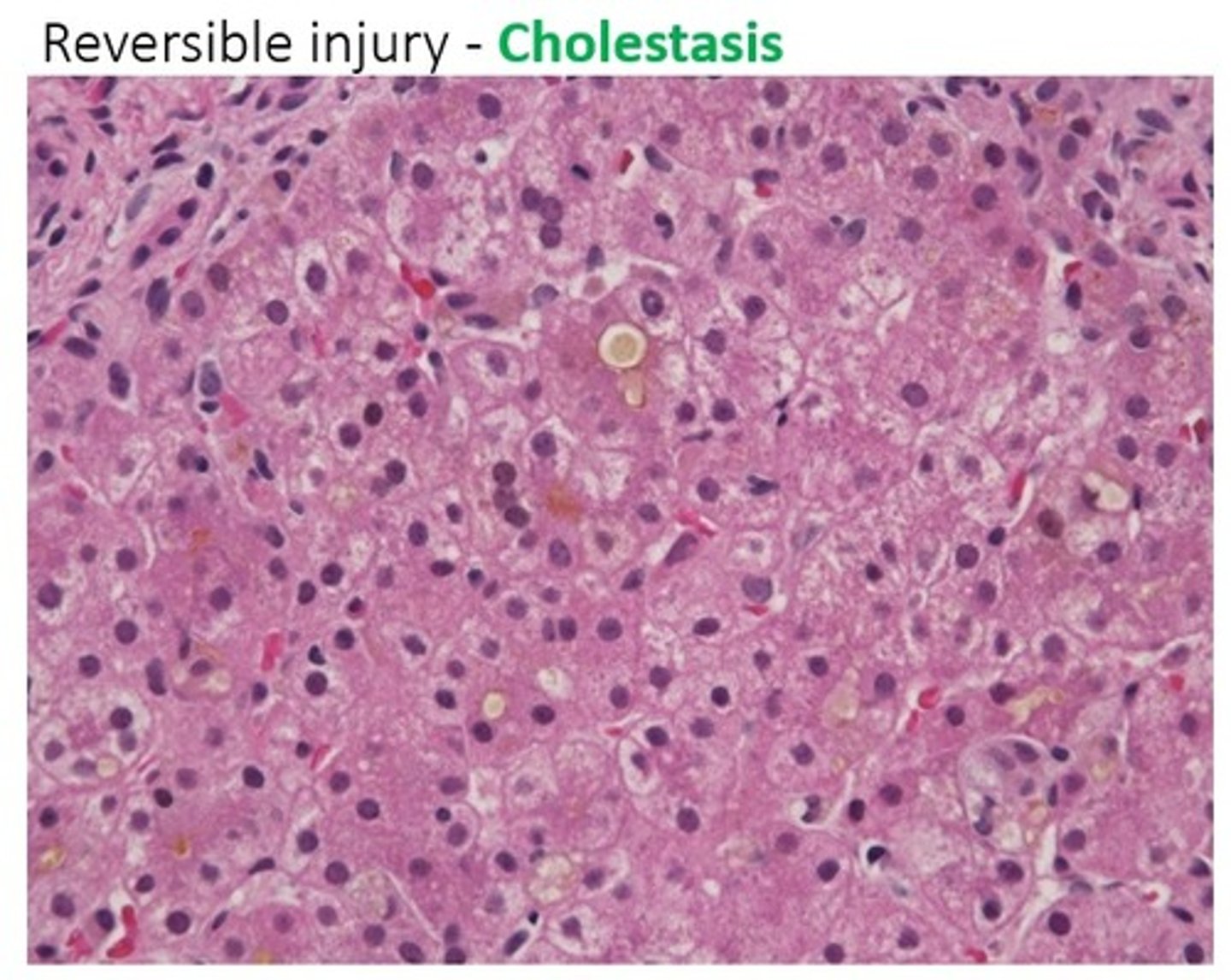 <p>What pattern of injury is seen with cholestasis, such as 2/2 bile stone obstruction?</p>