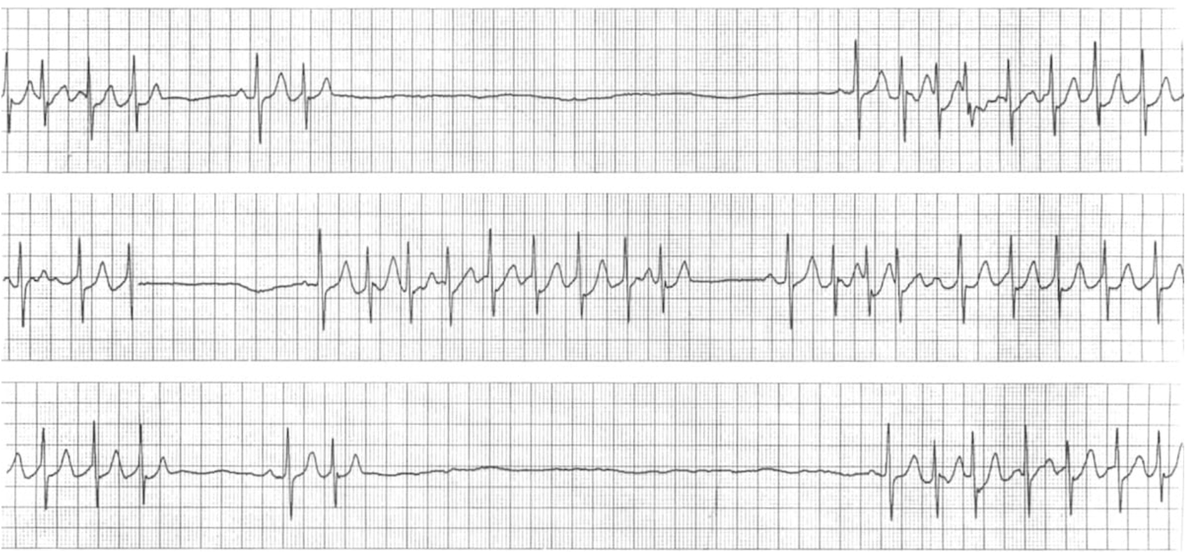 <p>Treatment of a patient with sick sinus syndrome that is symptomatic and bradycardic?</p>