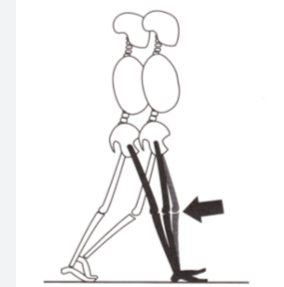<p><strong>Impairment:</strong> <span style="color: blue">Quadriceps weakness or spasticity</span> (often upper motor neuron lesion)<br><strong>Deviation/Compensation:</strong> <span style="color: red">Extensor thrust</span> — knee suddenly jerks into extension</p>
