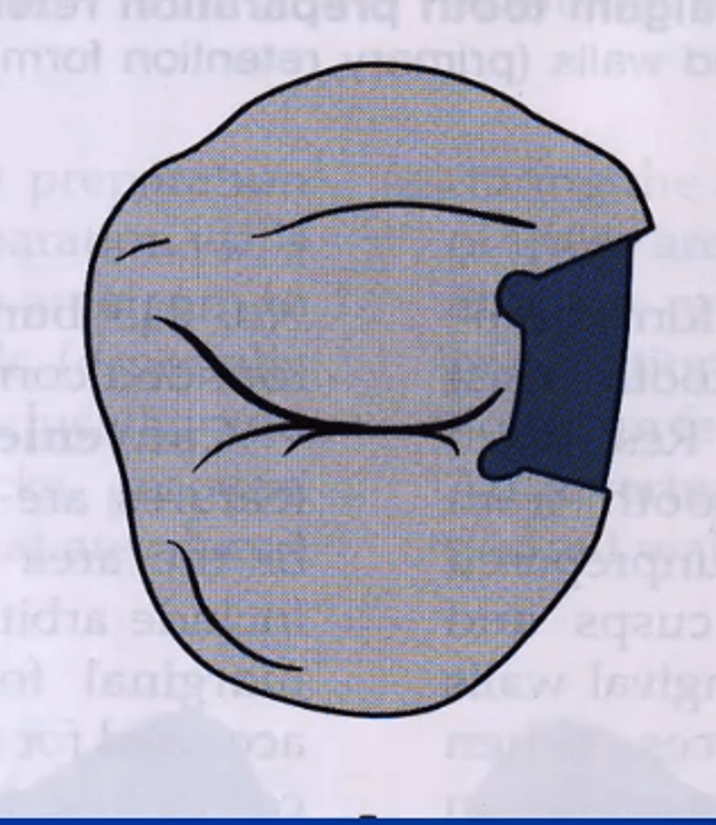 <p>when decay only involves proximal area (small lesion)</p>