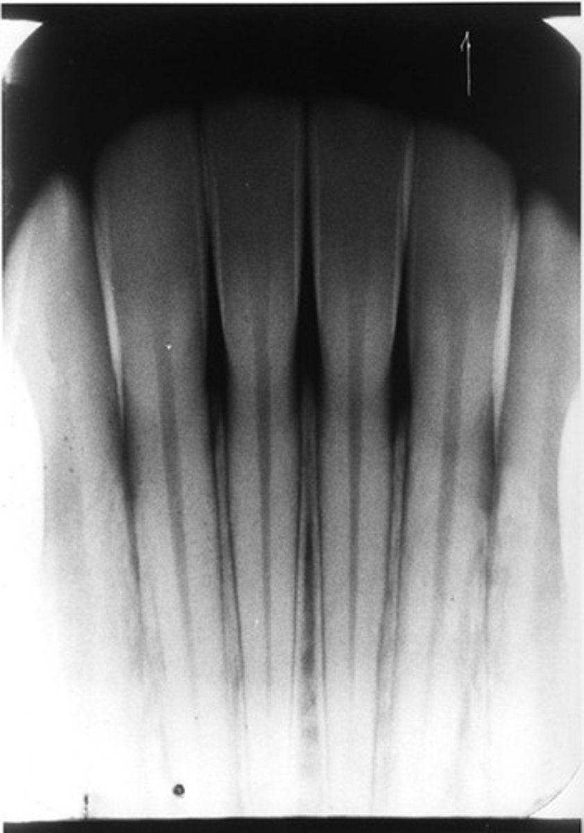 <p>what is the radiographic error?</p><p>a. foreshortening</p><p>b. elongation</p><p>c. improper horizontal angulation</p>