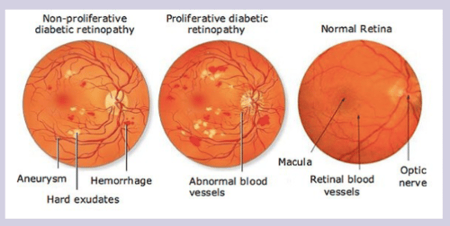 <p>Dx</p><p>-fundoscopic dilated eye exam </p><p>-annual screening in diabetic patients </p>
