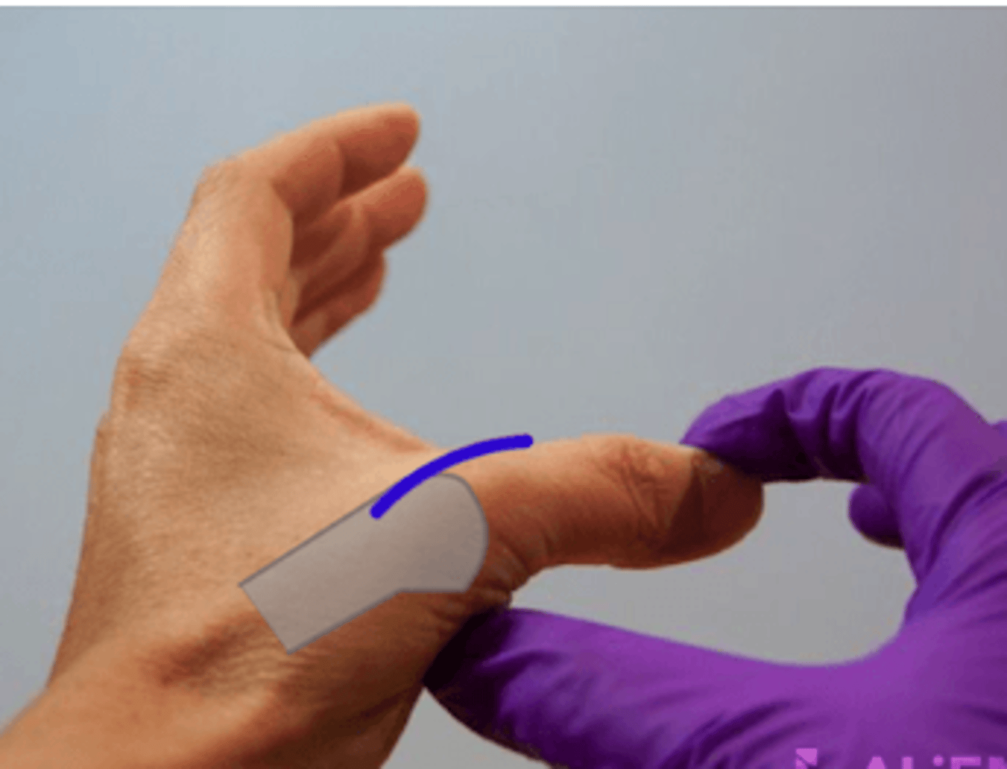 <p>Assesses Gamekeeper's thumb/ UCL ligament; + test is pain at UCL or valgus movement is >30-35º</p>