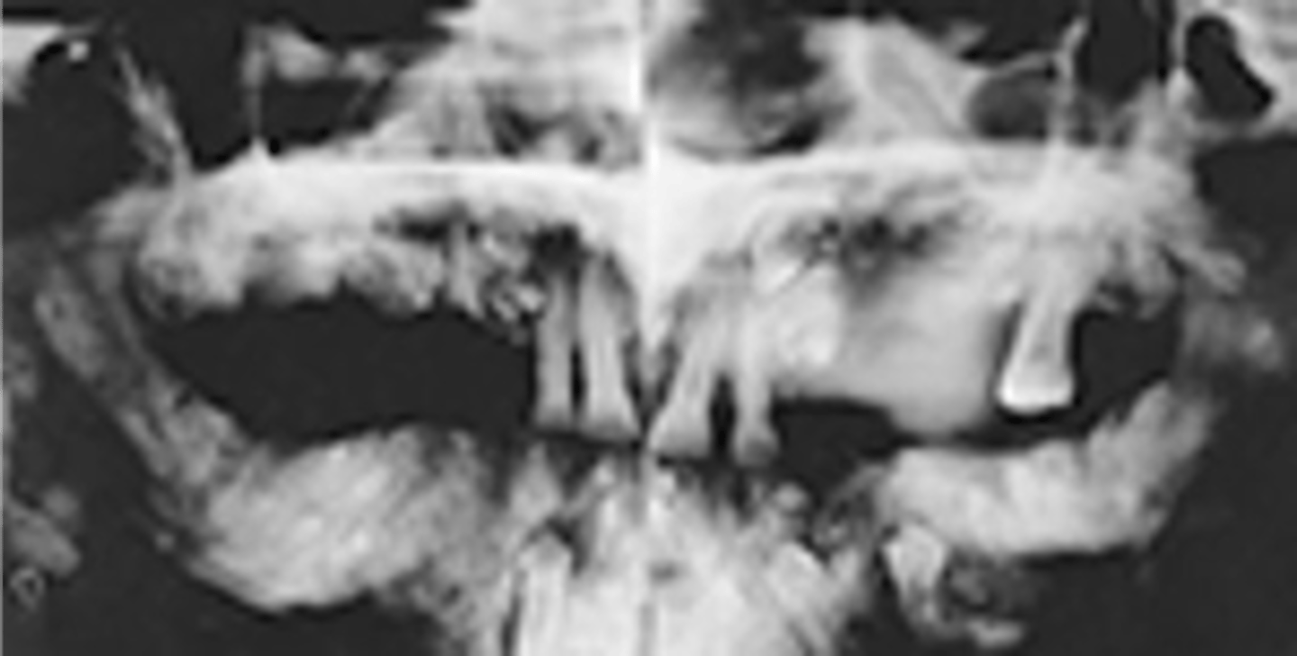 <p>Presence of osteomas in various bones of the skull</p>