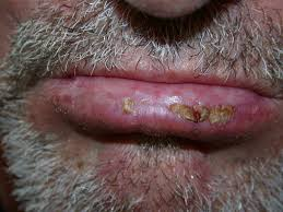 <p>PP: precancerous→squamous cell carcinoma</p><p>E: excessive exposure to sun<br>m/c→bottom lip</p><p>CM: lip loses redness→becomes scaly+thick+everted</p>