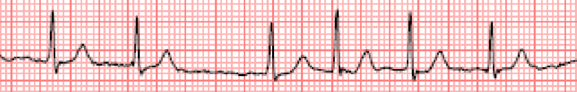 <p>most common pathologic arrhythmia, no p waves</p>