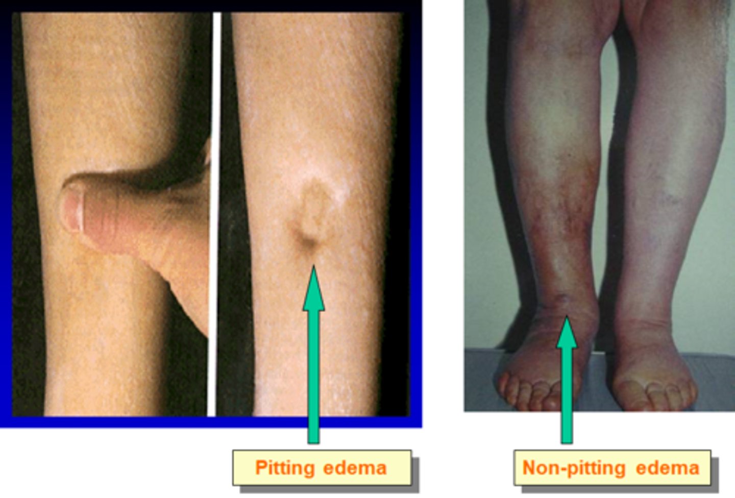 <p>early edema (pitting) vs progressed with fibrosis (non-pitting)</p>