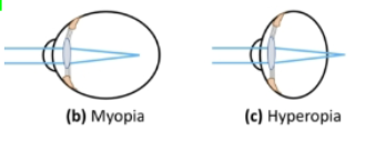 <p>are these refractive or axial? are the diagrams showing the eyes viewing at near or at an intermediare distance or far distance? how can u tell ?</p>