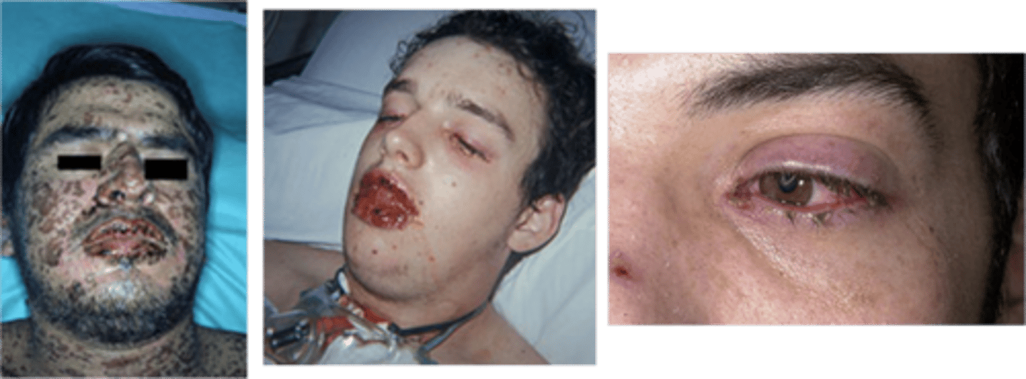 <p>Erythema multiforme major</p><p>Multiple mucosal surfaces are ulcerated</p><p>Usually triggered multiple medication use</p><p>Acute ulcerative condition of skin and mucous membranes</p><p>Immunologic response to foods, chemicals, drugs, or microbial infection</p><p>Hemorrhagic crusting of lips</p><p>"Bull's eye"</p>