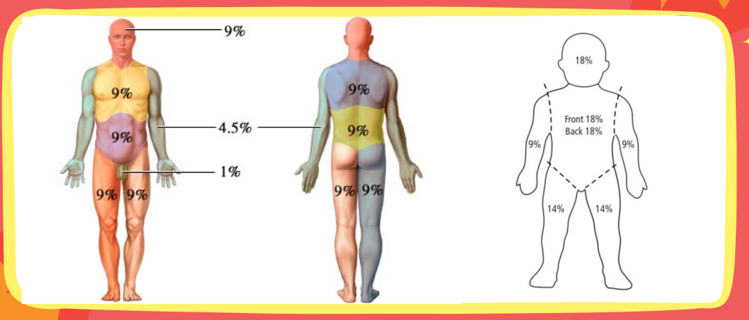 <p>Using the <strong>Rule of 9 </strong>—<strong> </strong>divide the body into areas of 9%</p><p></p>