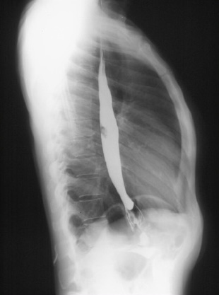 <p>What is this x-ray demonstrating?</p>