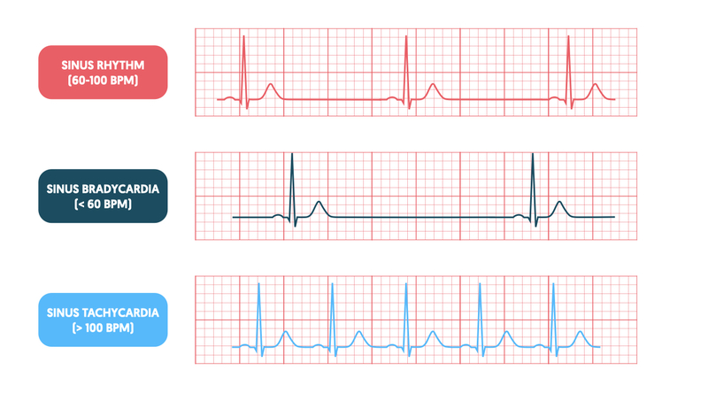 <p>Persistently high resting heart rate</p><p>Caused by heart disease, fever, anxiety</p>