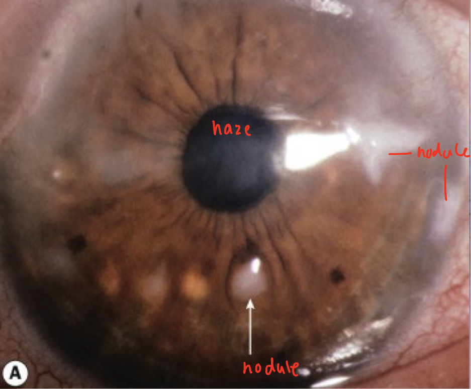 <ul><li><p><span><strong>Average age of onset</strong>: 59 years old</span></p></li><li><p><span>Female&gt;Male</span></p></li><li><p><span><strong>Cause</strong>: chronic corneal irritation or inflammation</span></p><ul><li><p><span>Trachoma, chronic blepharitis, chronic allergic keratoconjunctivitis, dry eye</span></p></li></ul></li><li><p><span><strong>Symptoms</strong>: <em>dryness</em>, foreign body sensation, decreased vision</span></p></li><li><p><span><strong>Presentation</strong>: superficial stromal opacities that progress to elevated whitish to blue-grey nodular lesions</span></p><ul><li><p>nodules are round or elongated</p></li><li><p><span>Nodules of <em>hyaline</em> tissue and are located anterior to Bowman layer</span></p></li></ul></li><li><p><strong>Treatment</strong>:</p><ul><li><p>lubrication</p></li><li><p><span>Surgery: superficial keratectomy, phototherapeutic keratectomy or lamellar keratoplasty</span></p><ul><li><p>smooths surface</p></li></ul></li></ul></li></ul><p></p>
