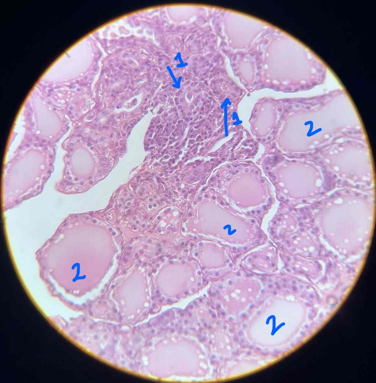 <p>Tiroide</p><p>1- cellule parafollicolari (endocrine)</p><p>2-follicoli (con secreto precursore di ormone tiroideo)</p>