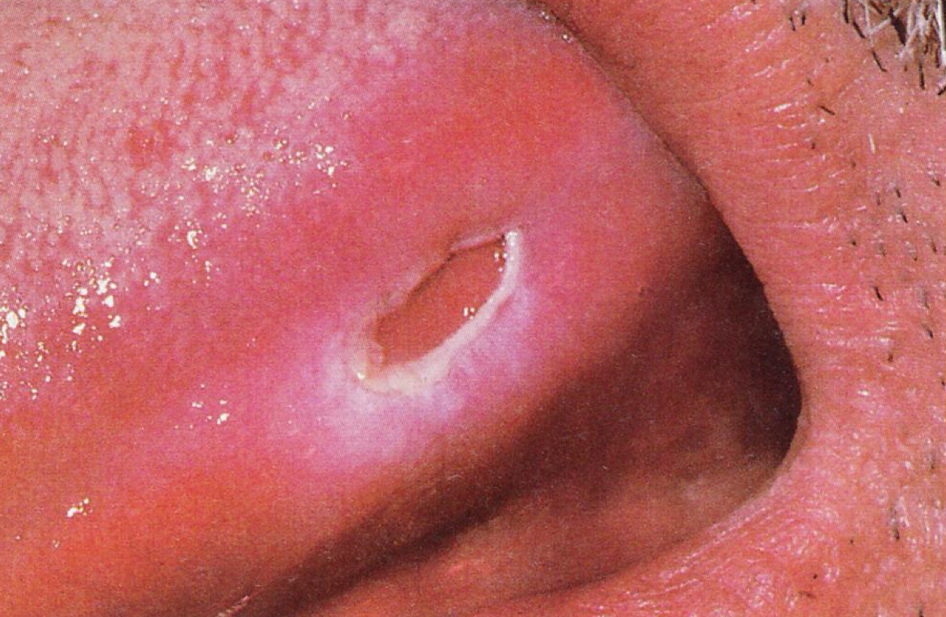 <p>Ulcer </p>